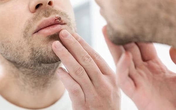 Czy&nbsp;z&nbsp;opryszczką można iść do&nbsp;dentysty?