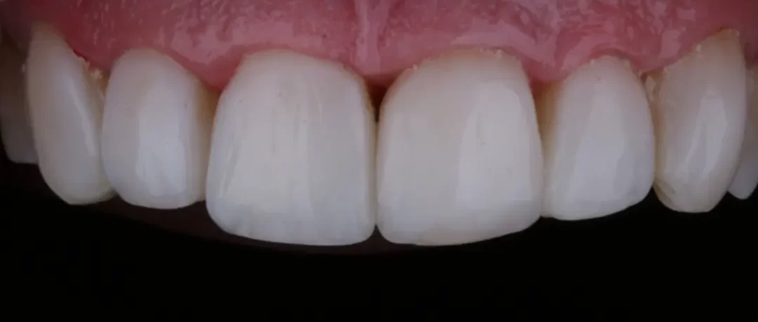 Bonding zębów Gdańsk , Ile kosztuje bonding - Markiewicz Clinic