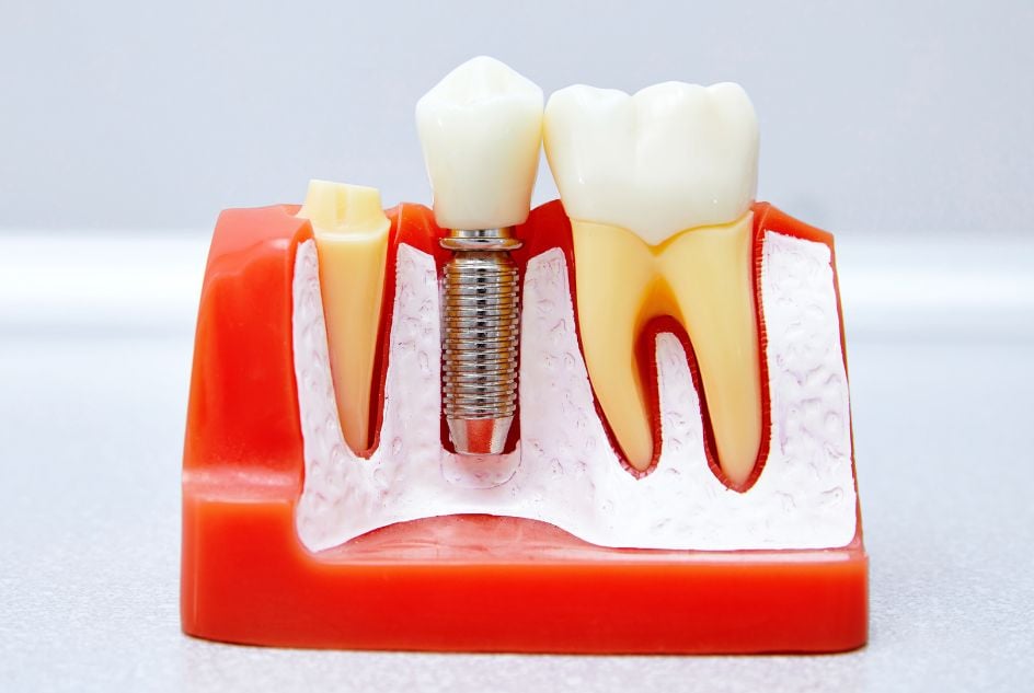 czym zastąpić implant zęba