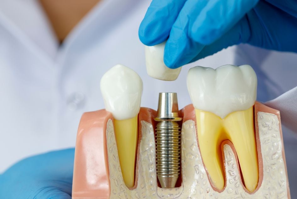 implant zęba