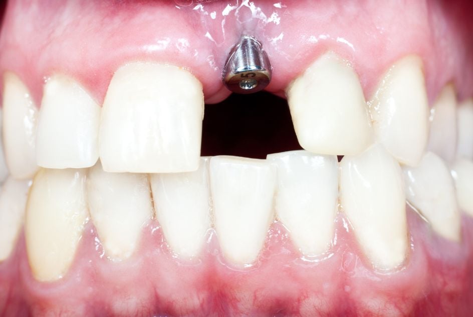 nieprzyjęcie się implantu