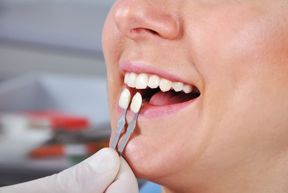 różnica między bondingiem a licówkami