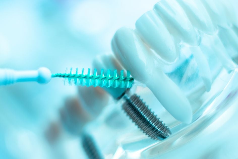 jak myć zęby z implantami