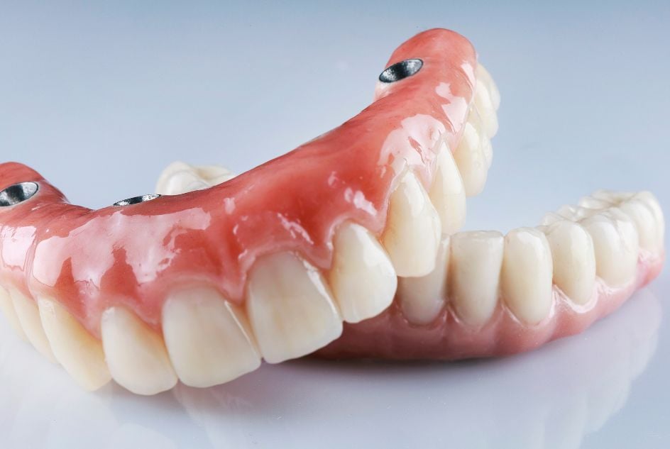 jak wygląda proteza zębów na implantach