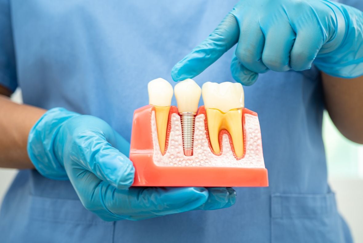 dental implants safe