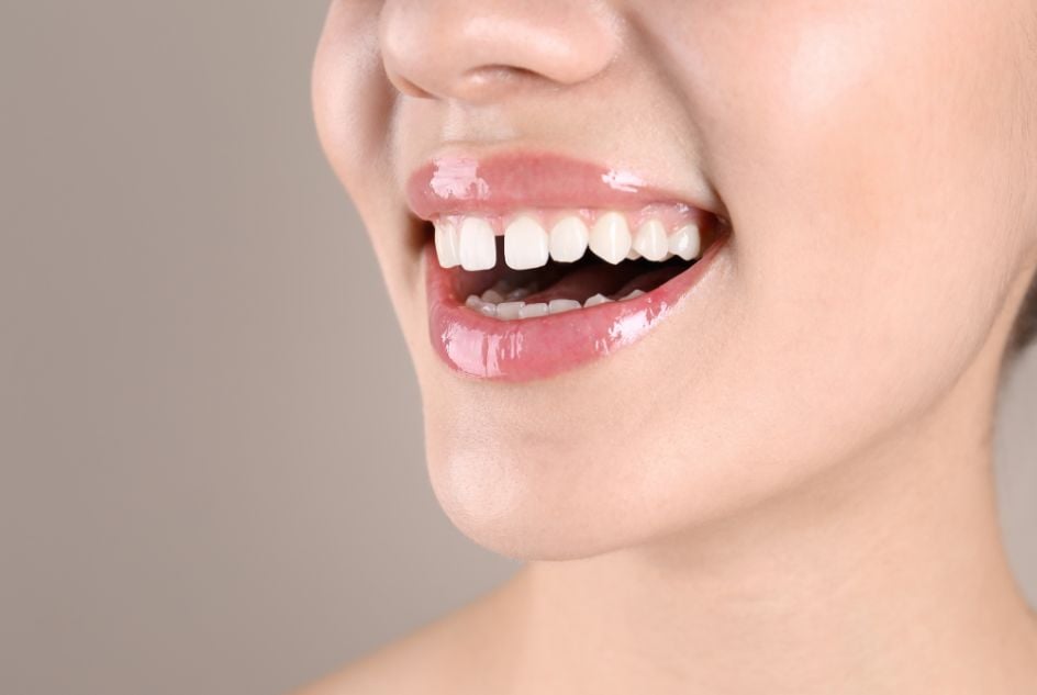 diastema a leczenie stomatologiczne