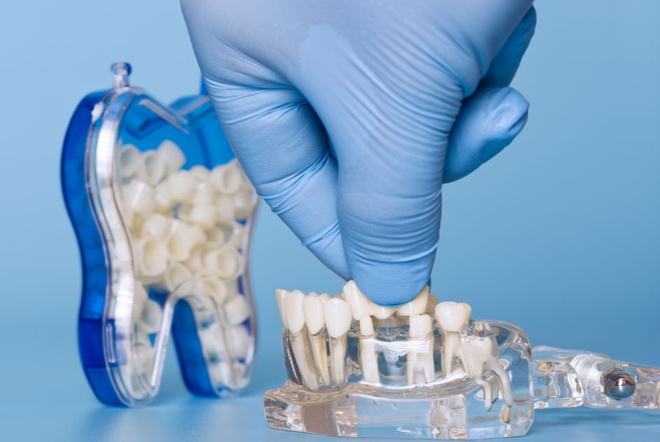 korony na implantach