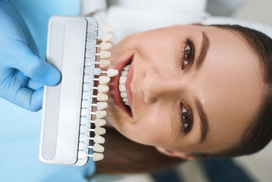 Veneers