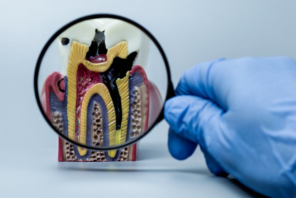 koszt leczenia próchnicy zębów